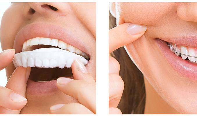 Rembourssement Mutuelle Orthodontie 